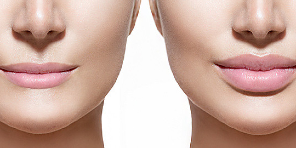 Lip Fillers in Delhi: Everything You Need to Know