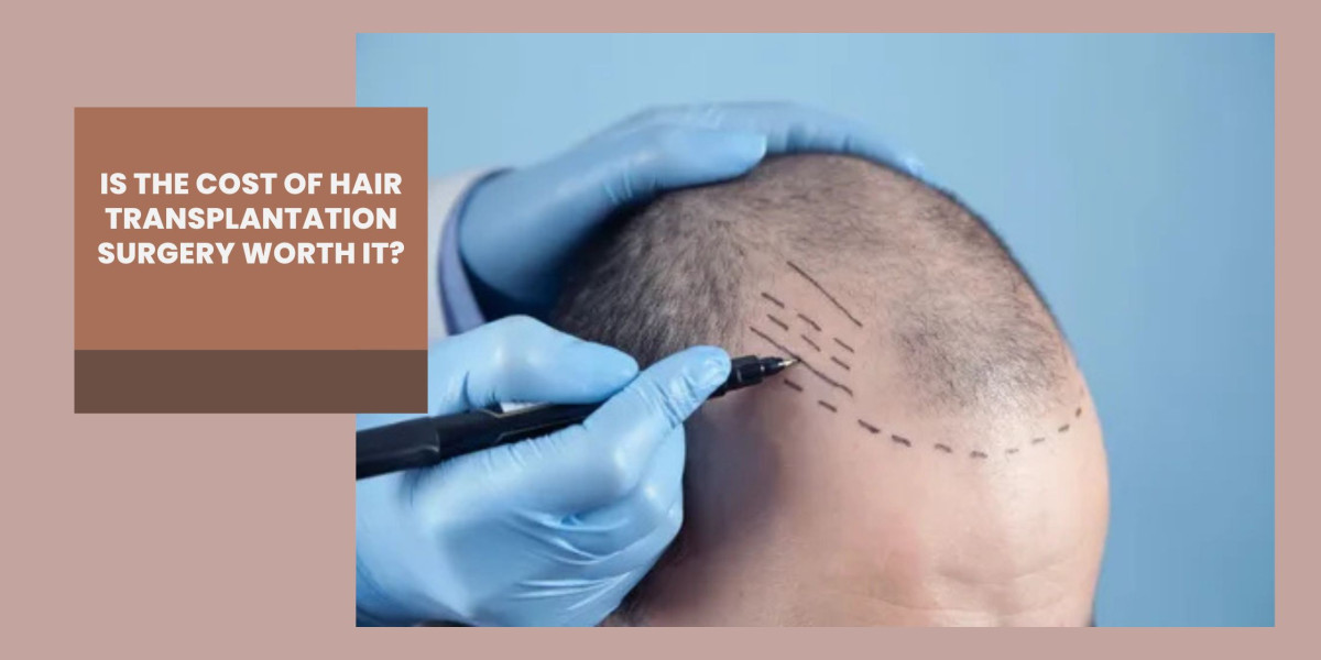 Is the Cost of Hair Transplantation Surgery Worth It?