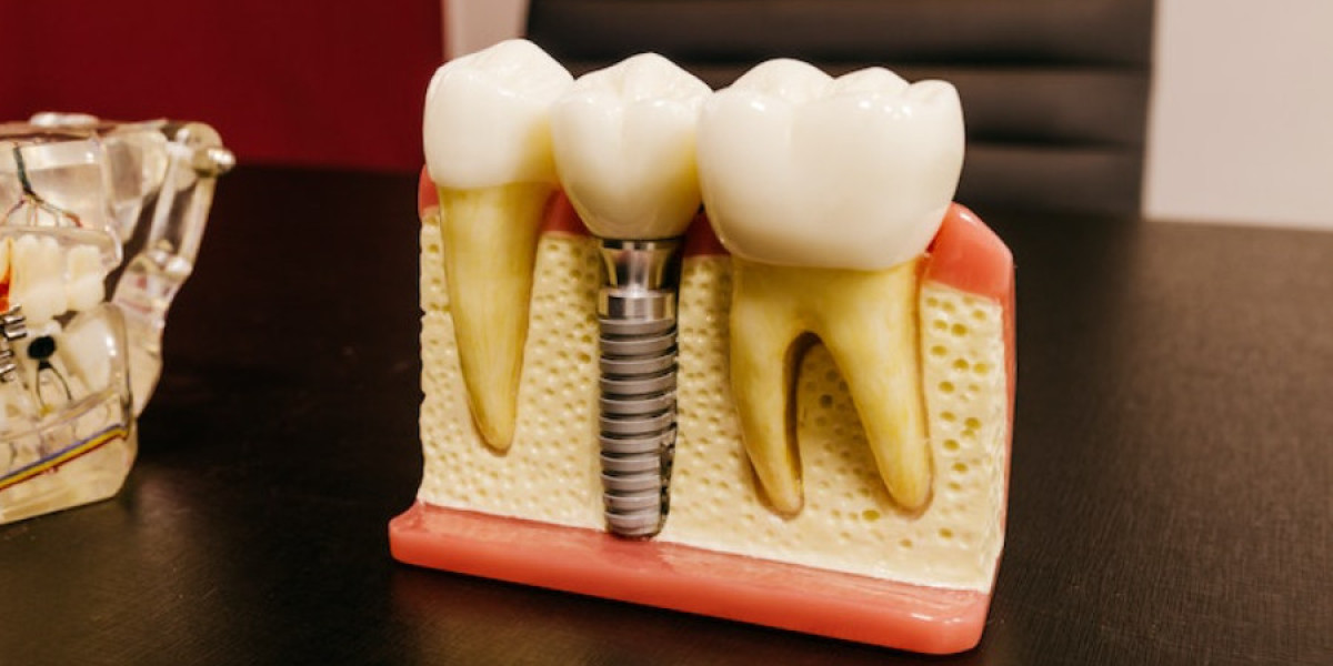 Best Implant Dentists in New Jersey – Excellence in Smile Restoration