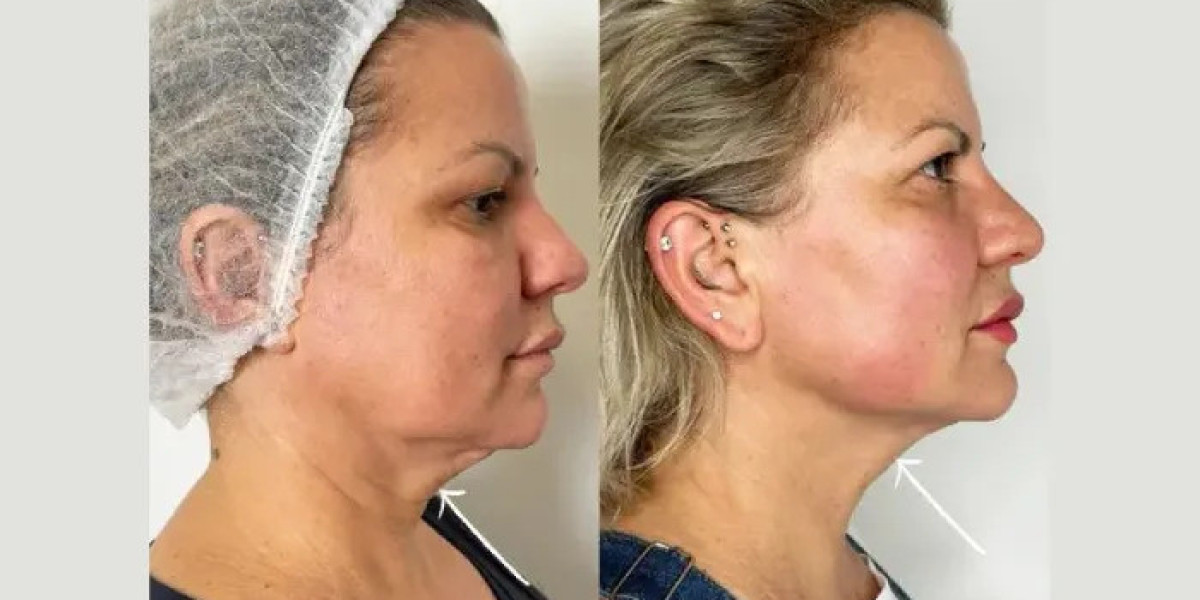 Best Doctors in Dubai for Endolift Treatments