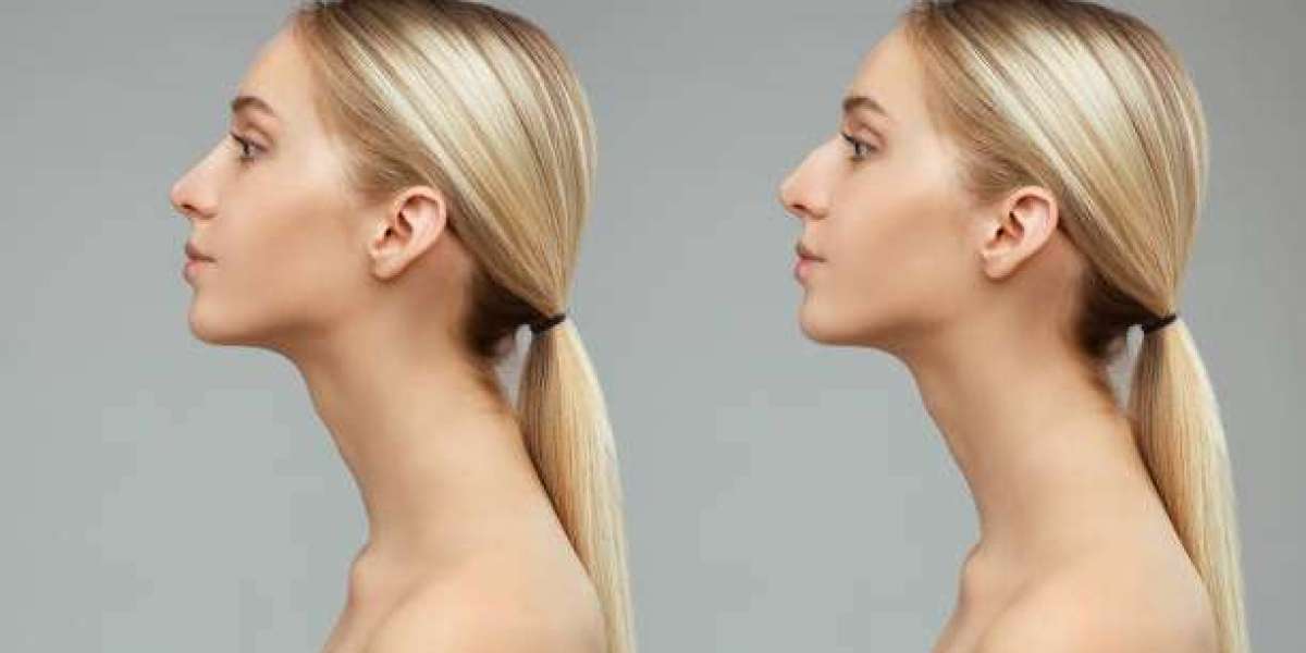 How Ancestry Shapes Rhinoplasty Goals?