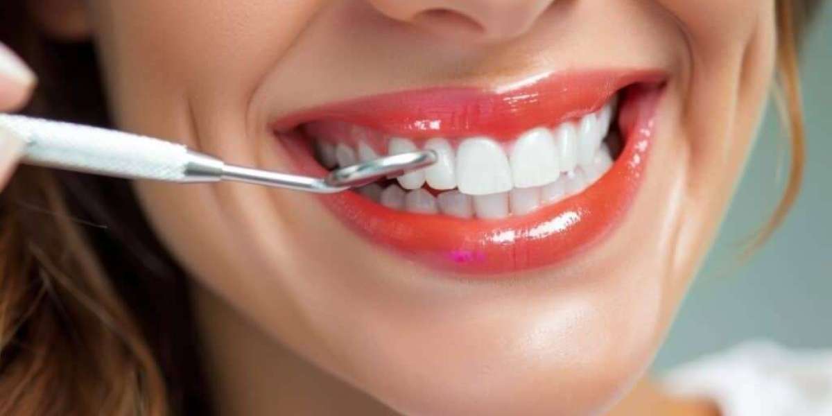 Step-by-Step Dental Veneers Procedure