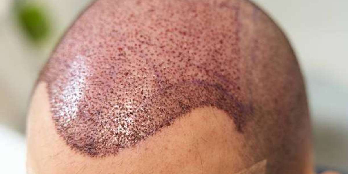 Hair Transplant Techniques that Create Balanced Hairline Designs