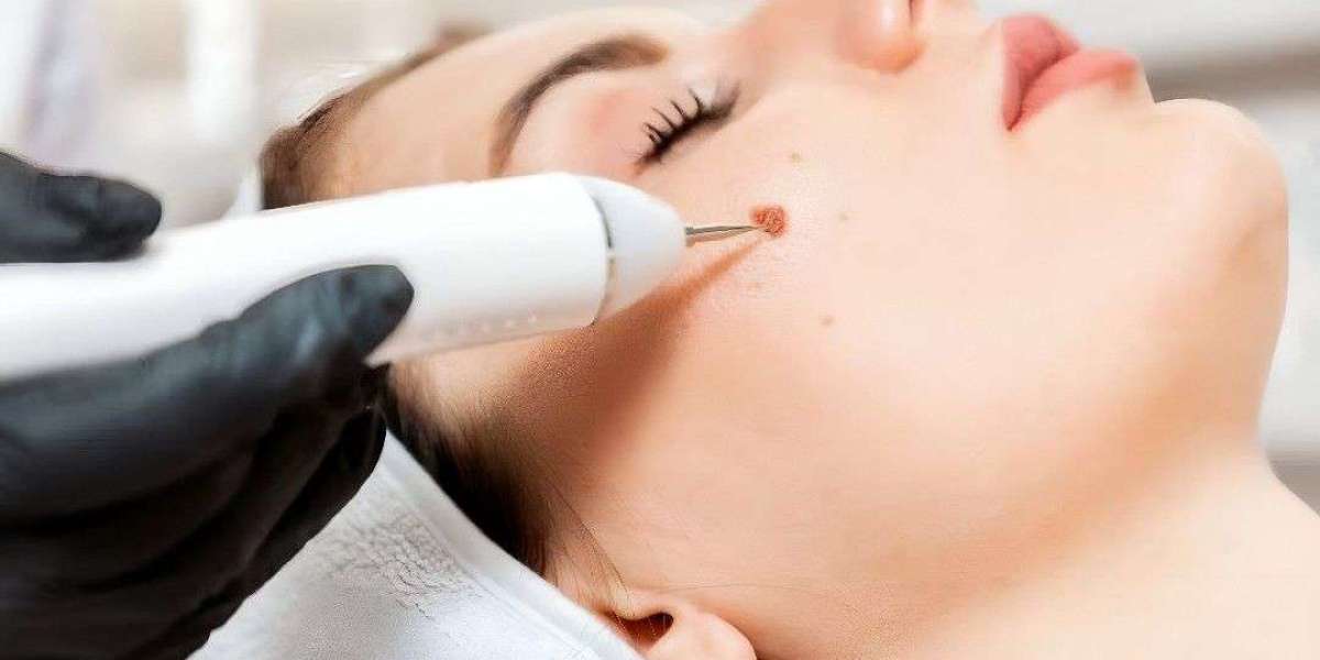 Remove Warts Today – Islamabad Trusted Clinics