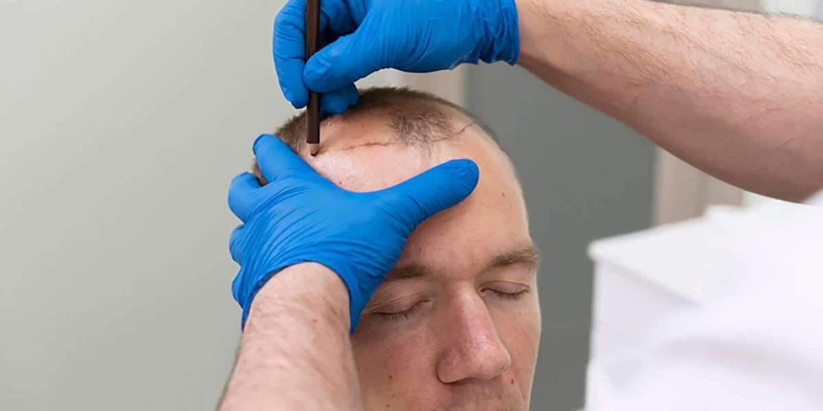 Hair Transplant Treatment for Baldness Correction