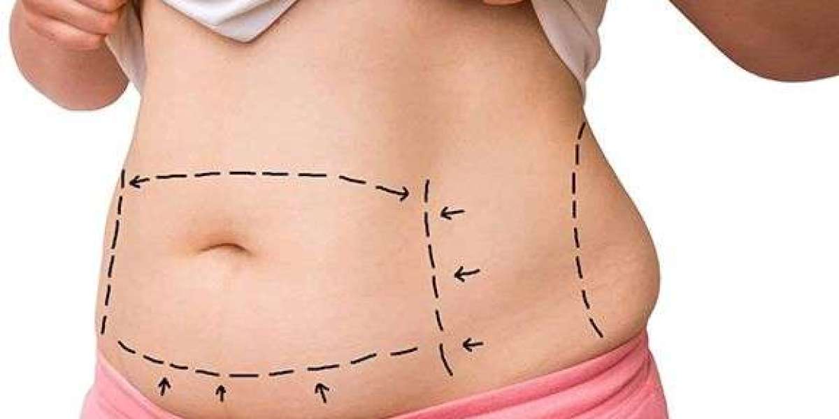 Royal Clinic Saudia: Where Liposuction Meets Precision and Safety