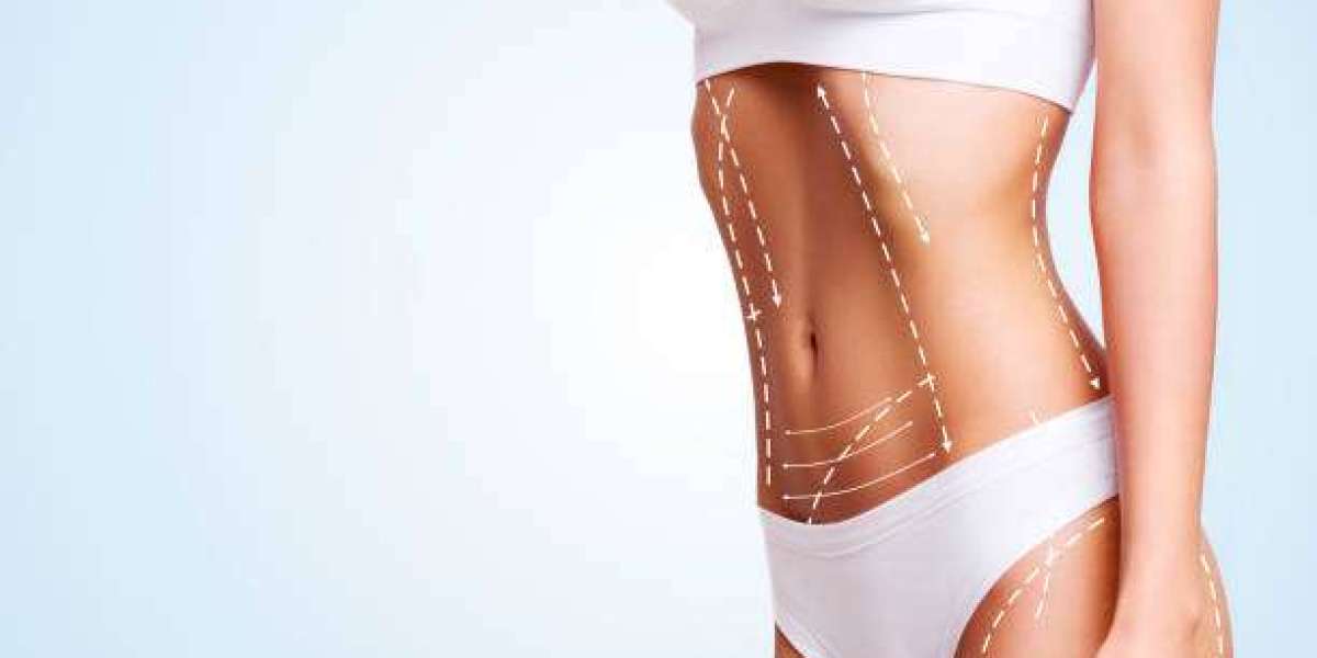 BodyTite Magic: Liposuction for Sleek, Contoured Body