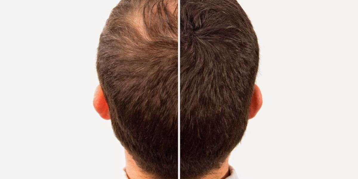 Stop Hair Loss Naturally with Stem Cell Technology