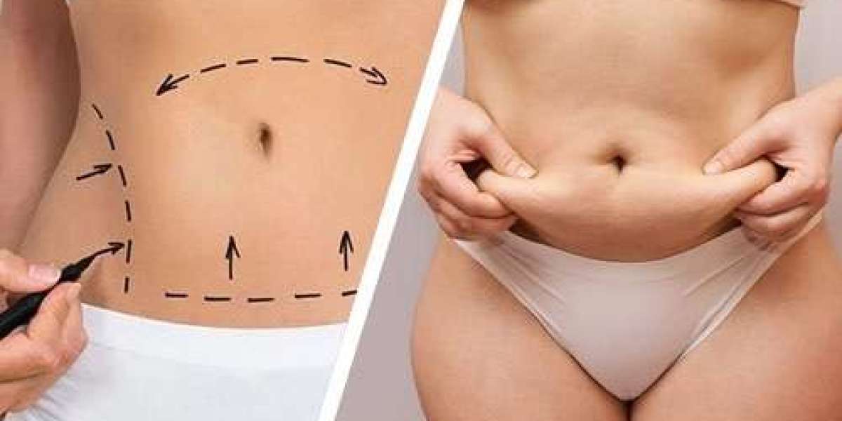 Liposuction in Islamabad and why contour results vary between bodies