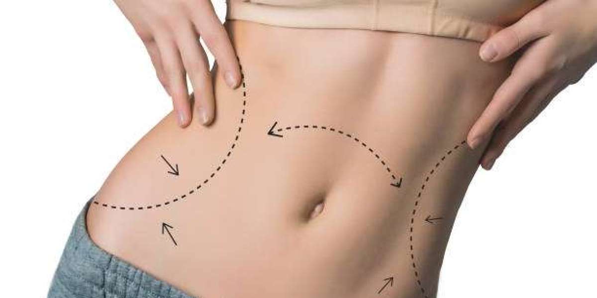 Liposuction to Achieve a Slimmer Body Profile