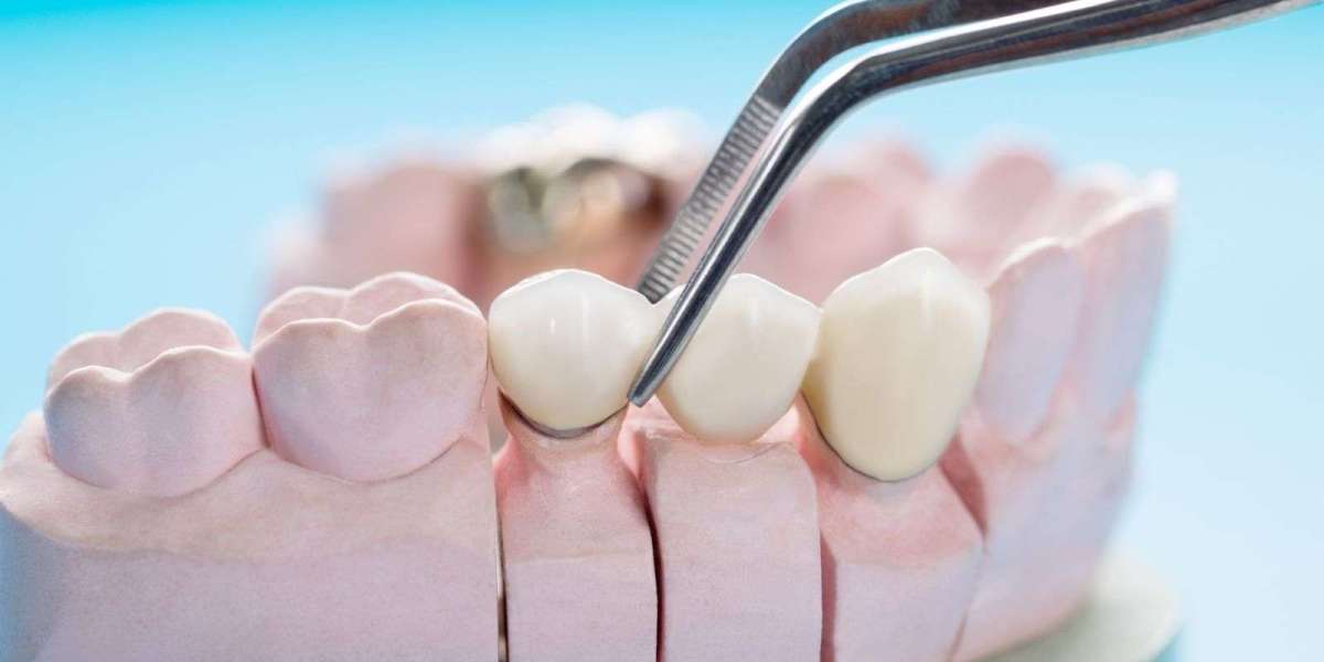 Dental Implants in Dubai for Full Mouth Restoration