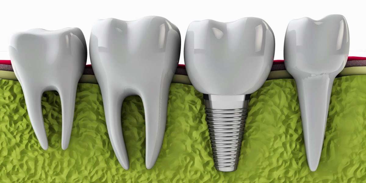 Dental Implants for Missing Teeth: What to Know