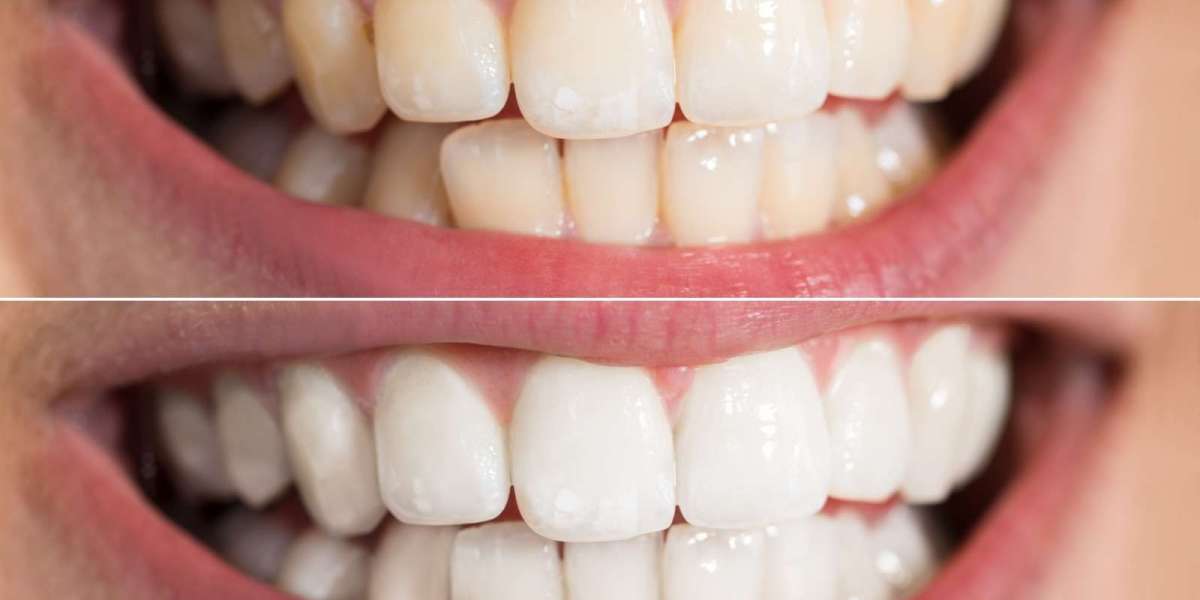Teeth Whitening: What to Know Before Treatment