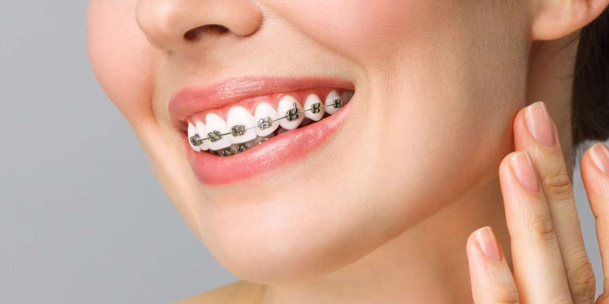 Dental Braces in Dubai: How the Treatment Works