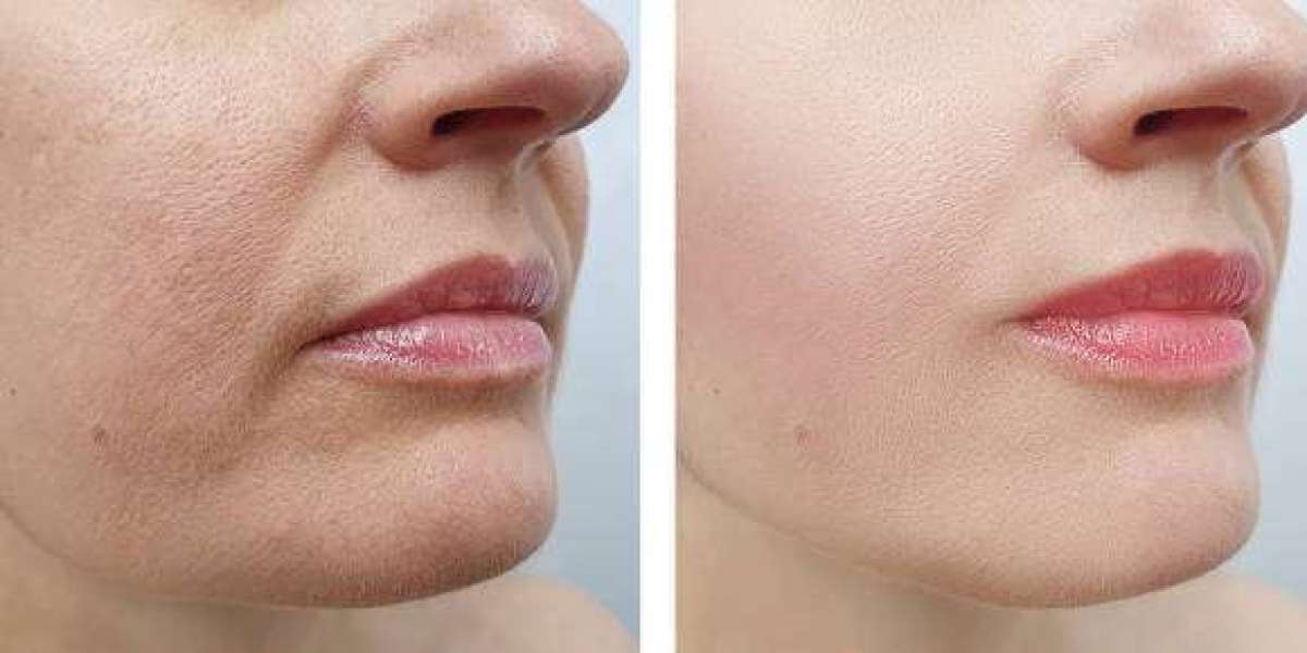 Can Sculptra Fillers in Dubai Improve Facial Volume Loss?