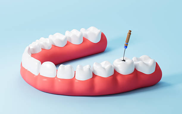 Can Root Canal Therapy Prevent More Expensive Tooth Replacement Later? – Telegraph