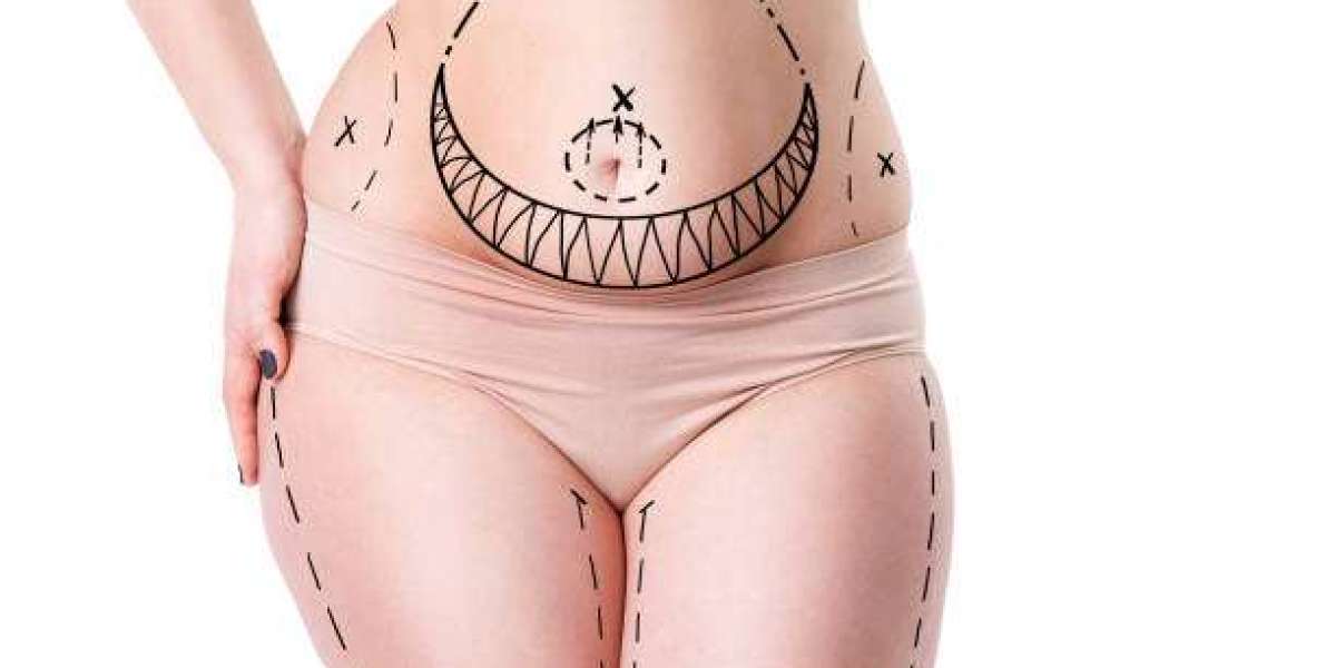 Liposuction Options for Enhancing Natural Body Curves