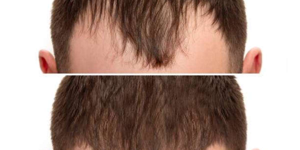 Can Hair Transplant in Dubai Give You Natural Hair Results?