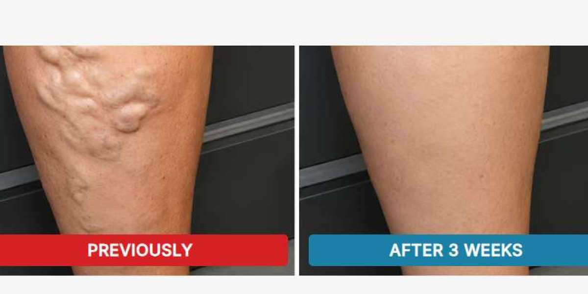 Venorela Varicose Veins Cream UK