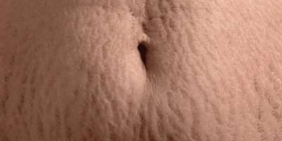 Can Stretch Mark Removal in Islamabad Help Restore Smoother-Looking Skin?