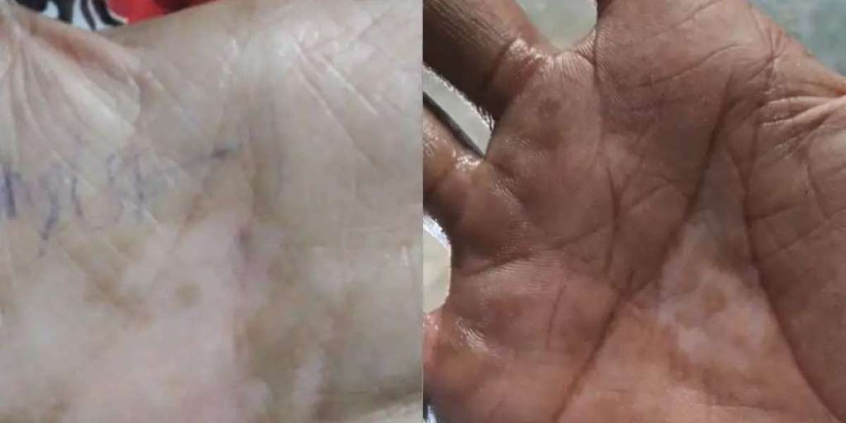 Vitiligo Treatment Patna: Understanding Treatment Options