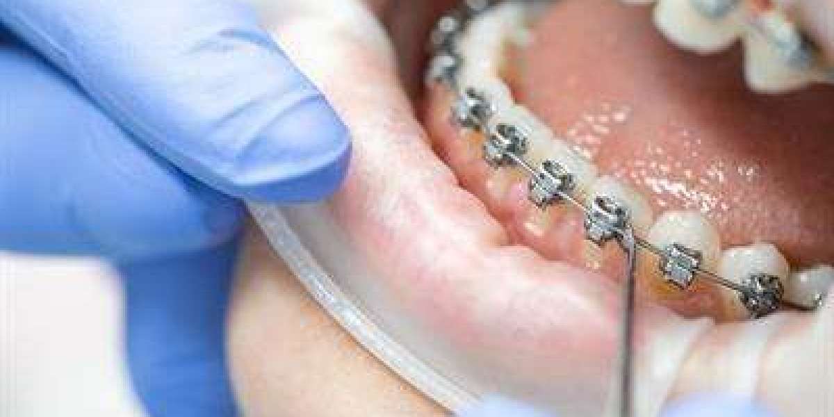 Can Dental Braces in Islamabad Help With Rotated Teeth?
