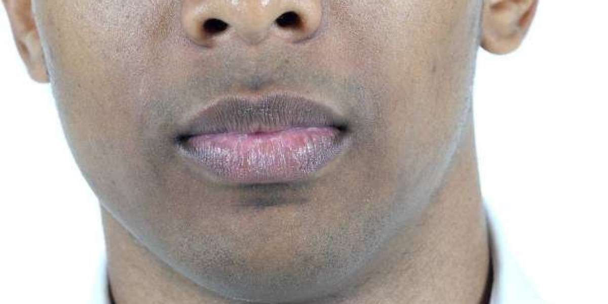 Smoker’s Lips Treatment for Restoring a Fresh and Natural Lip Appearance