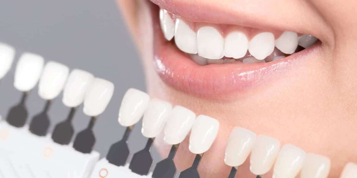 Is the Veneers Cost Worth It