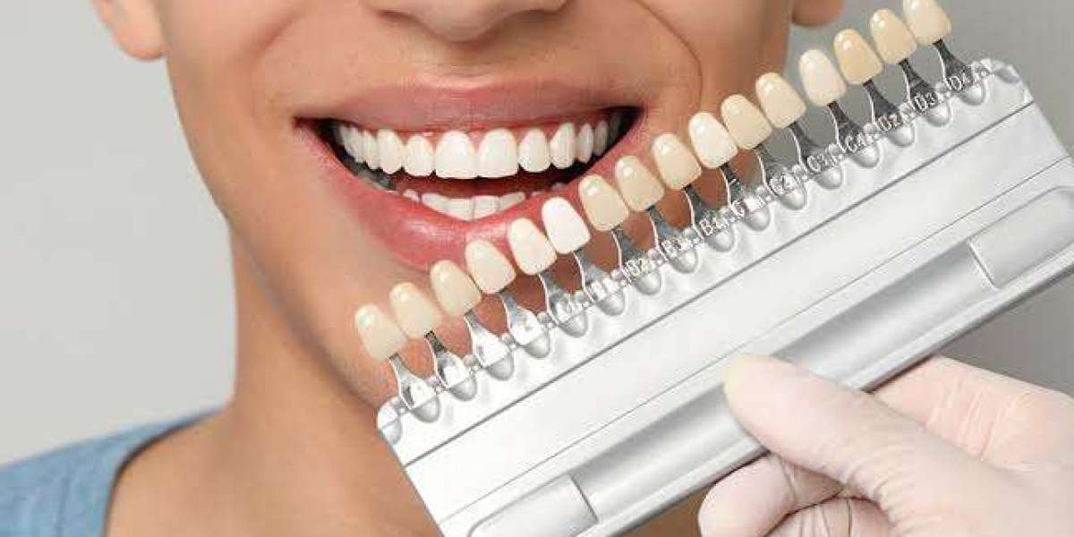 How Experienced Dentists Approach Veneer Treatment in Islamabad