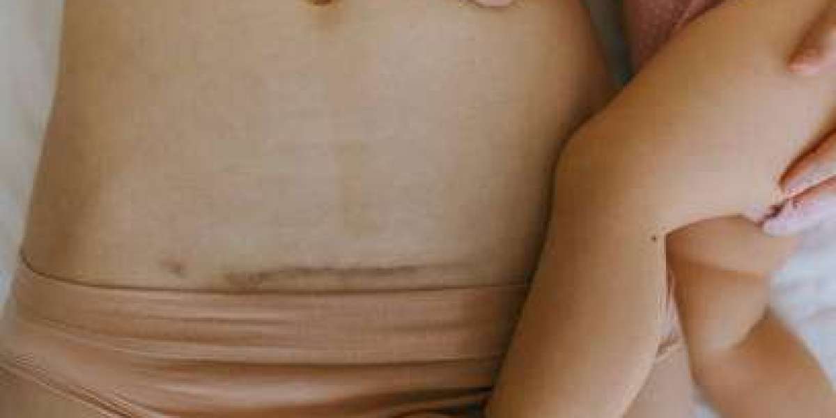 Mommy Makeover and What to Know Before Choosing Treatment