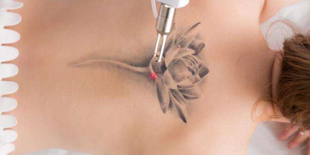How Clinic Experience Can Influence Your Tattoo Removal Journey