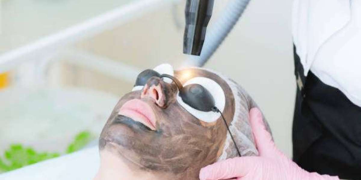 Spectra Laser Carbon Peel for Enhancing Natural Skin Radiance