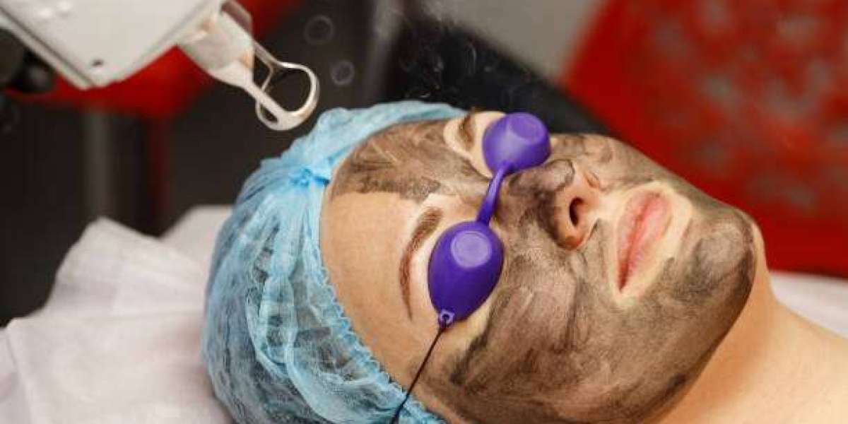 How Spectra Laser Carbon Peel Works to Refresh and Renew the Skin