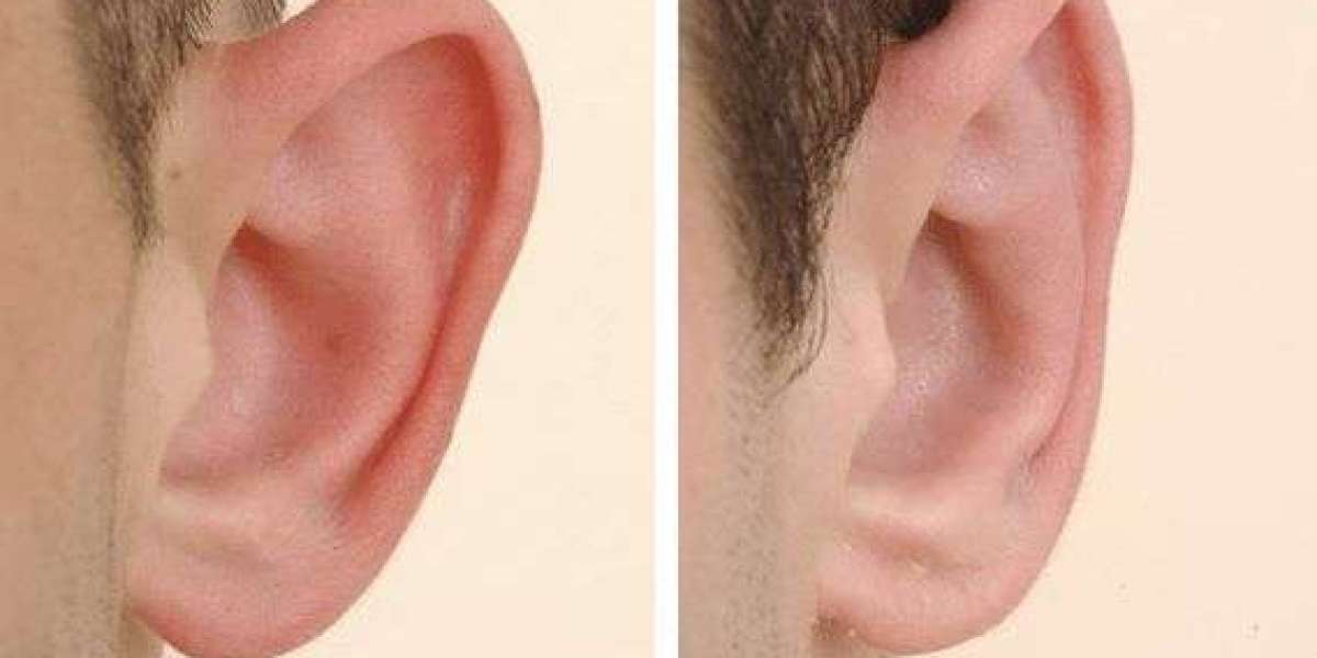 How Ear Reshaping Can Support Your Aesthetic Goals