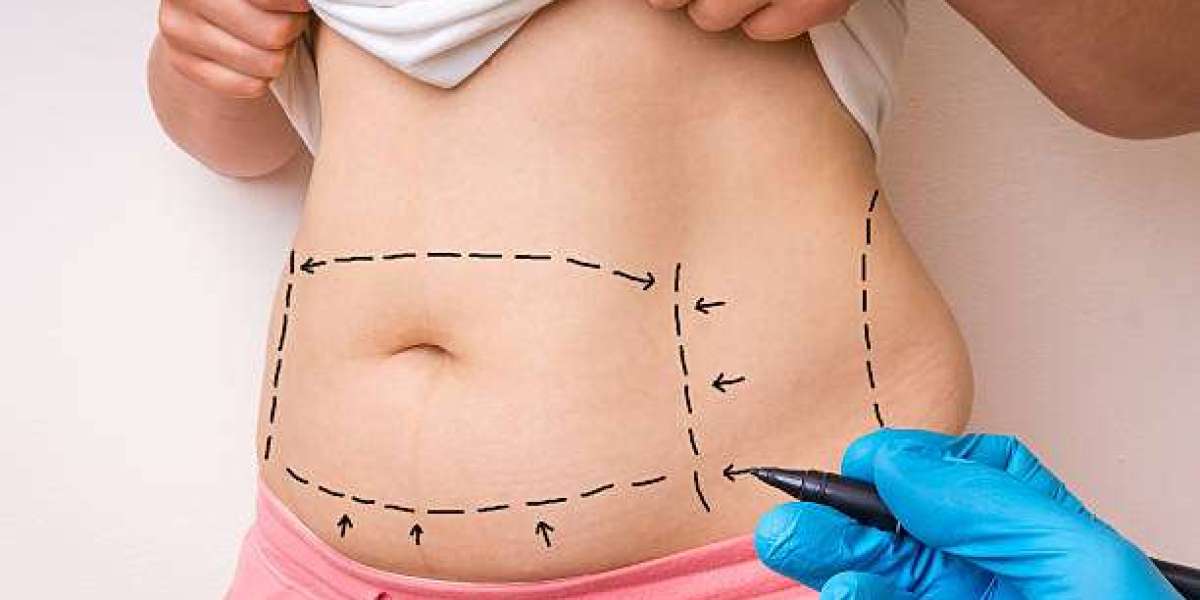 Exploring the Role of Fat Melting Injections in Body Sculpting