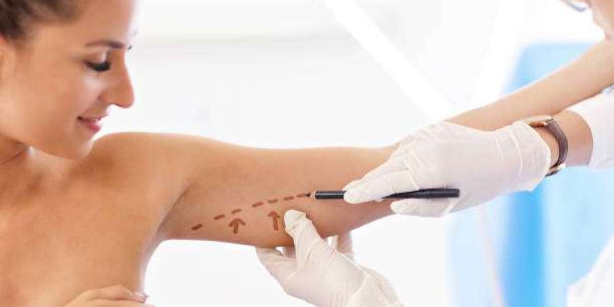 Arm Lift Surgery Insights for Achieving Refined Arm Definition