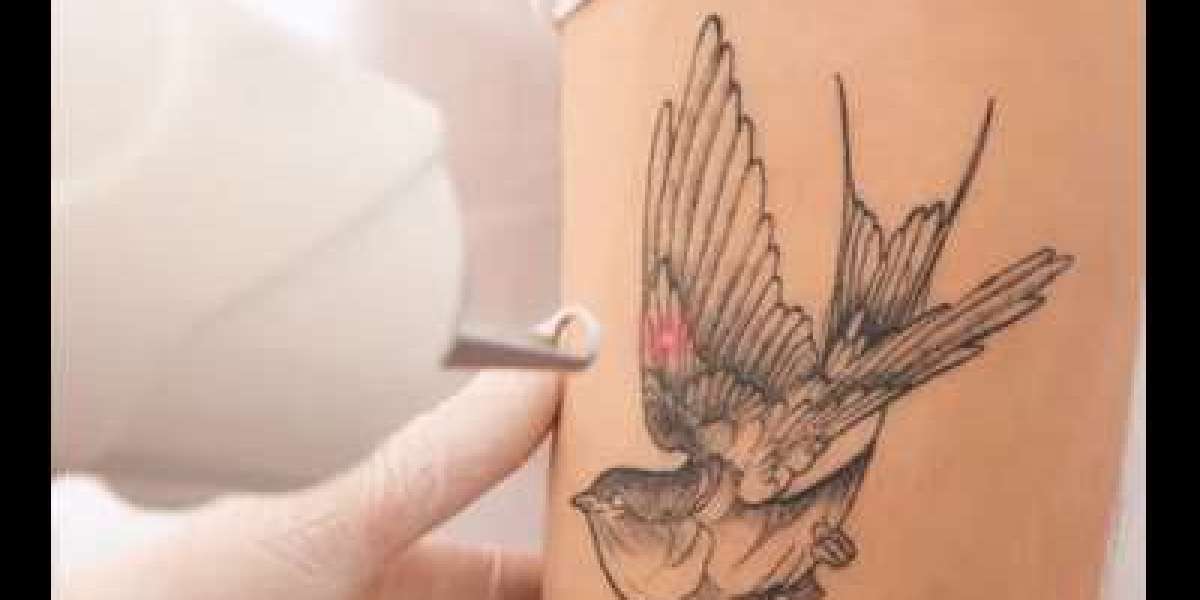 Is Laser Tattoo Removal Painful? What to Expect During Treatment
