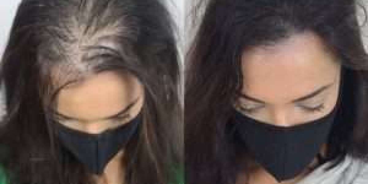 How Long Does Scalp Micropigmentation Last?