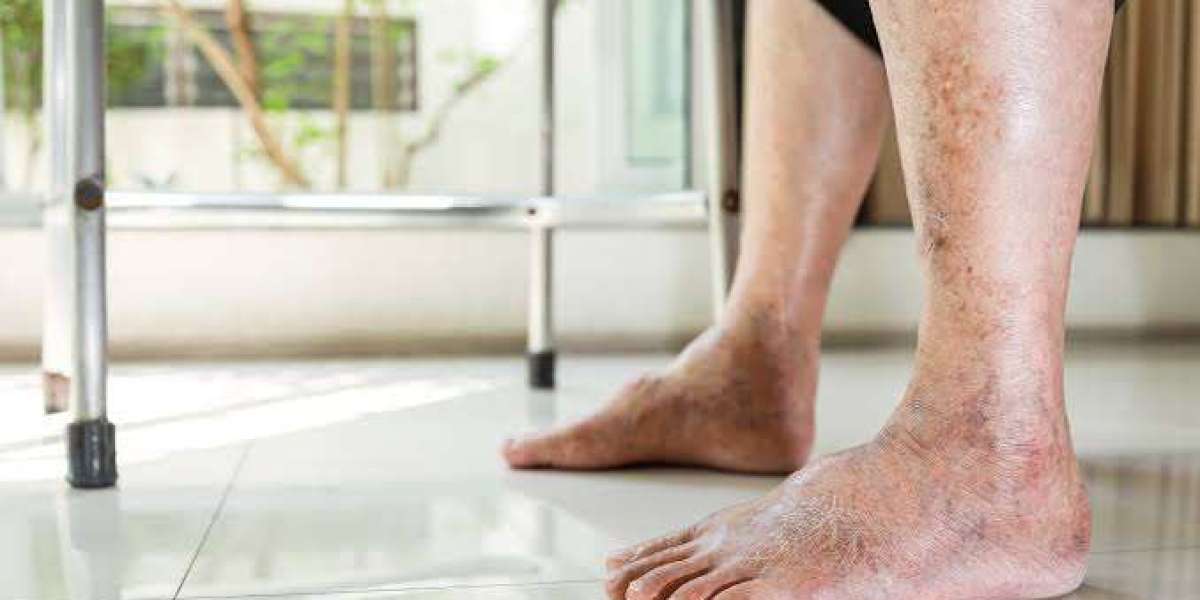 Why Do Legs and Feet Swell After Standing for Long Hours?
