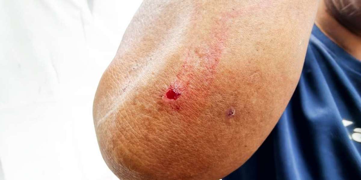 Can Obesity Affect Psoriasis? What the Research Shows
