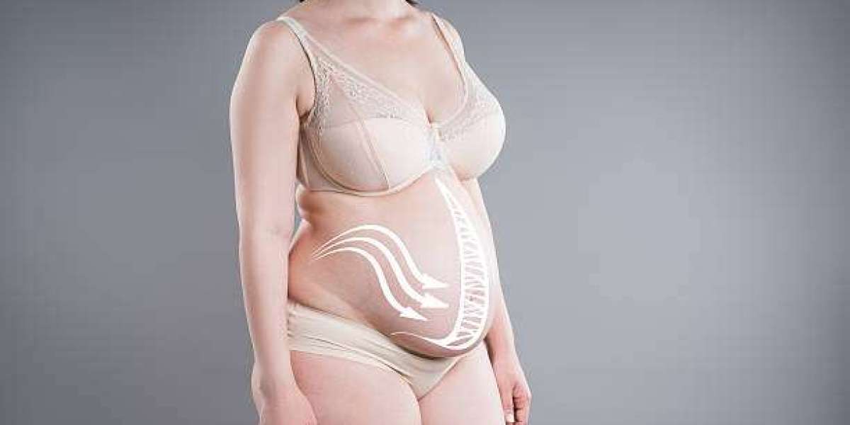 Tummy Tuck Surgery and the Journey Toward a More Refined Silhouette